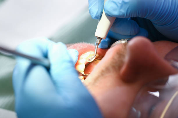 Best Emergency Tooth Extraction in Anza, CA